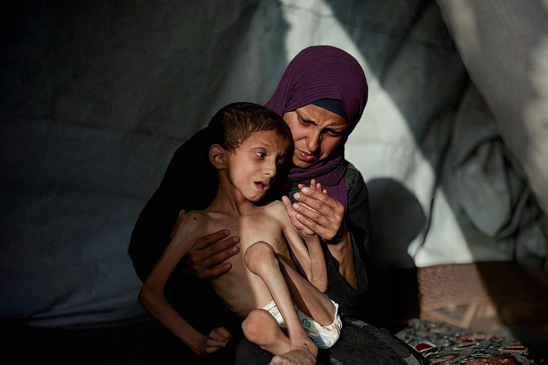 Darurat ! Kasus Malnutrisi Akut pada Anak di Gaza